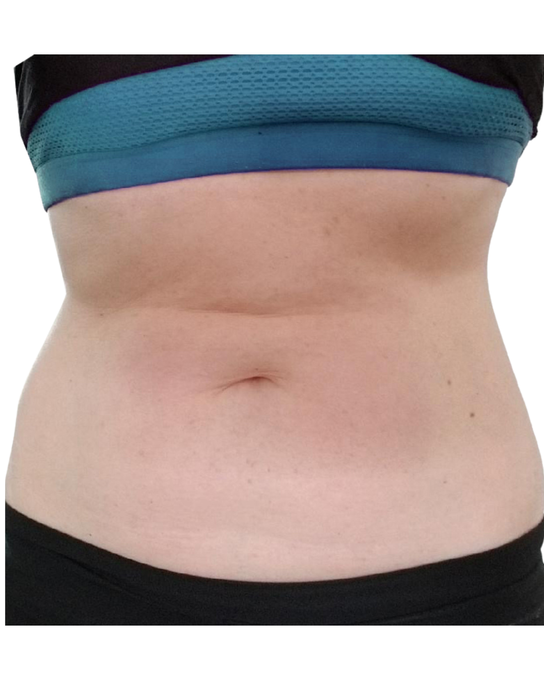 after fat freezing suzie