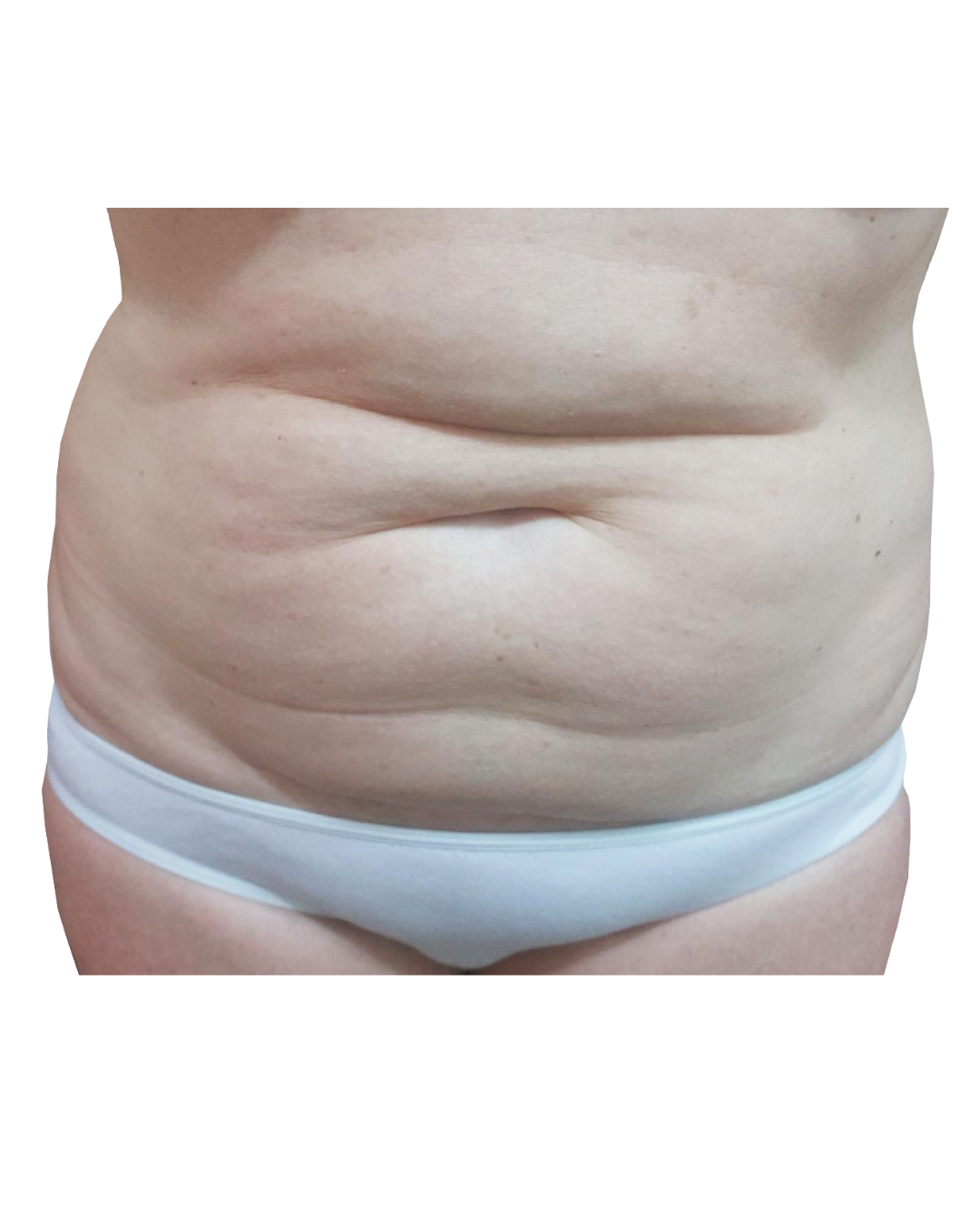 before fat freezing 1